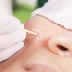 Khám phá hiệu quả rõ rệt của chấm TCA trong trị sẹo chân đá nhọn