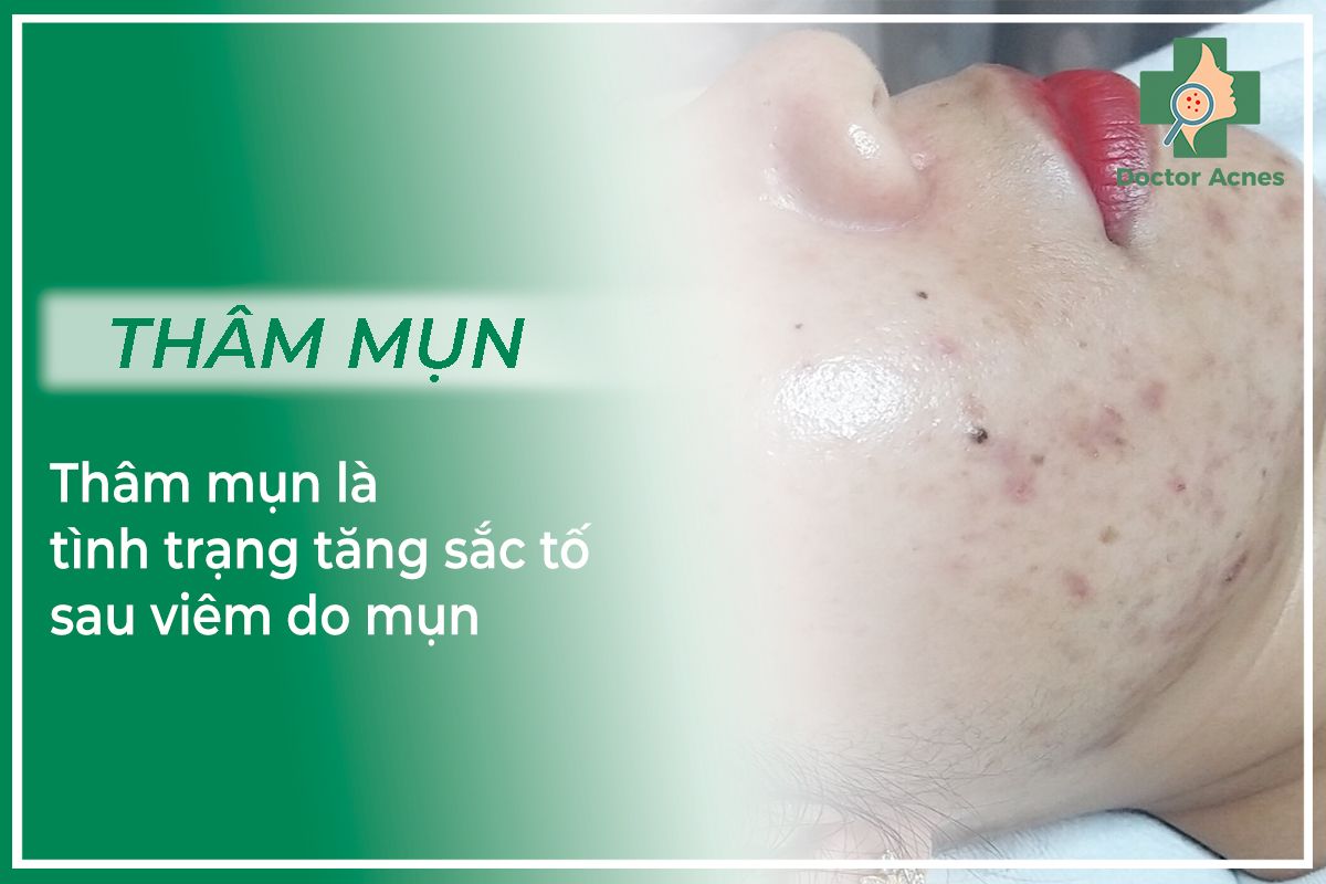 Thâm mụn tăng sắc tố sau viêm