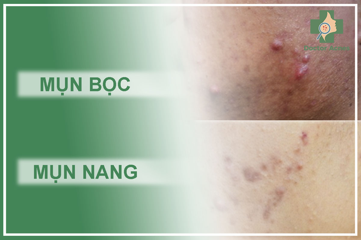 Mụn nang, mụn bọc - Phòng Khám Doctor Acnes