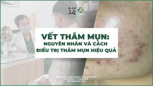 vết thâm mụn nguyên nhân và cách điều trị thâm mụn hiệu quả