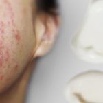 Nguyên nhân da bị nhiễm corticoid và dấu hiệu nhận biết