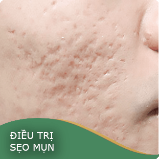 Điều trị sẹo mụn