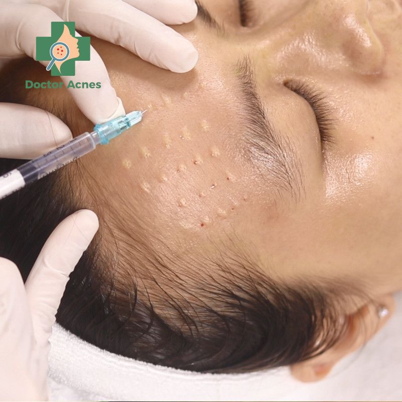 Mesotherapy PRP