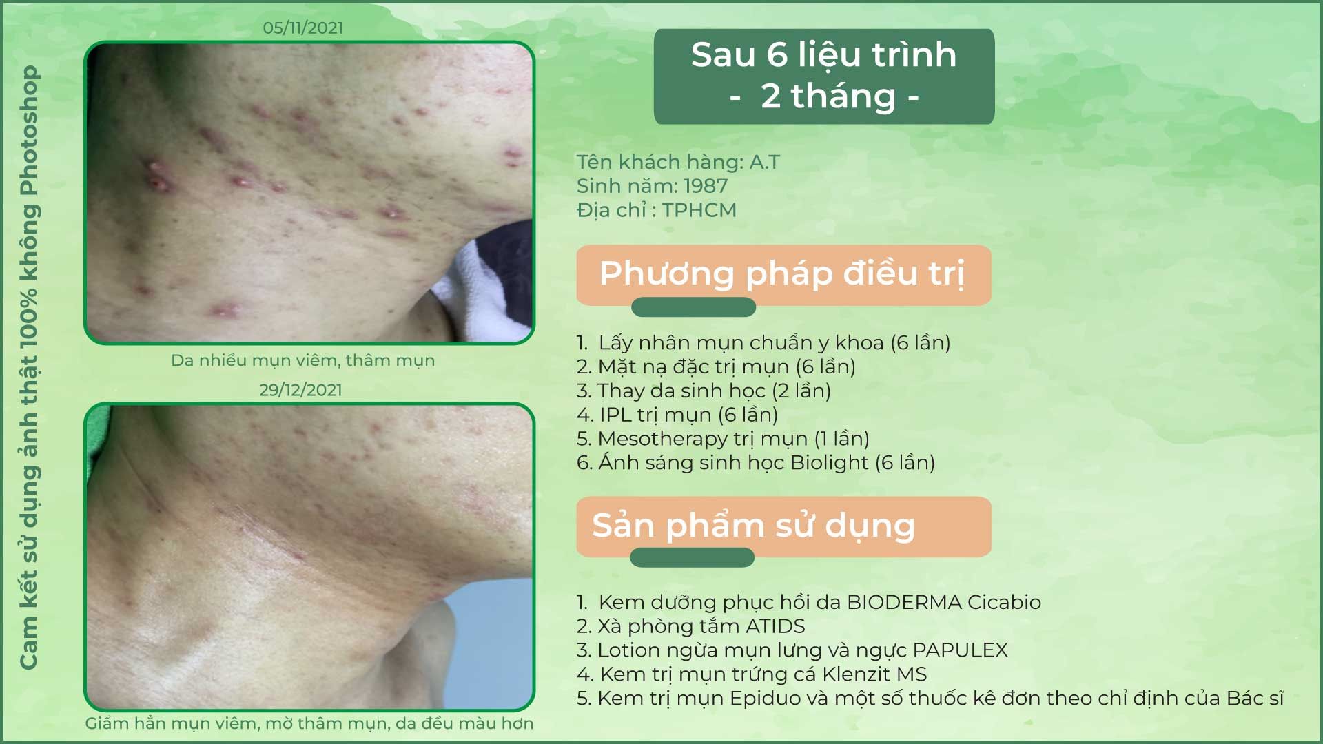 cls mụn cho người trưởng thành