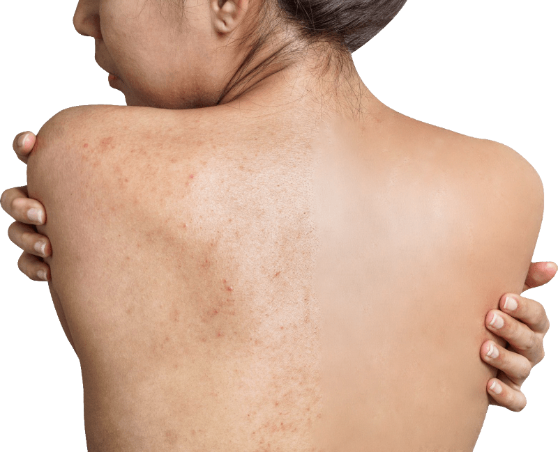 điều trị mụn lưng Doctor Acnes