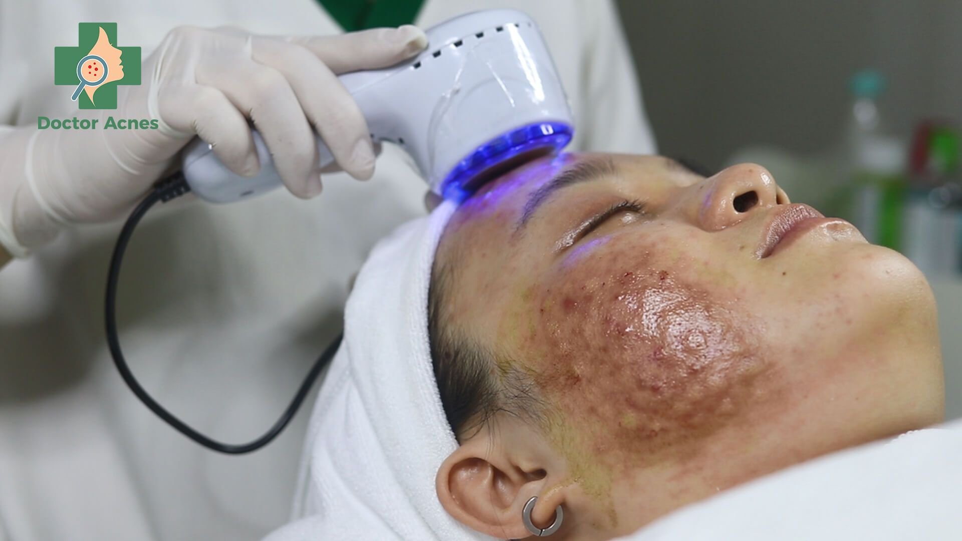 Sử dụng búa lạnh đã được vô khuẩn áp lên vị trí tiêm giúp thư giãn làn da và giảm độ phồng nốt tiêm