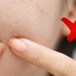 Có nên nặn mụn không? Các hướng dẫn điều trị da liễu hiện hành khuyến cáo ra sao?