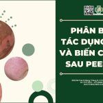 Phân biệt tác dụng phụ và biến chứng sau peel da