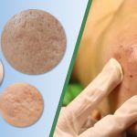 Các cách hỗ trợ tăng sinh collagen khi điều trị sẹo rỗ