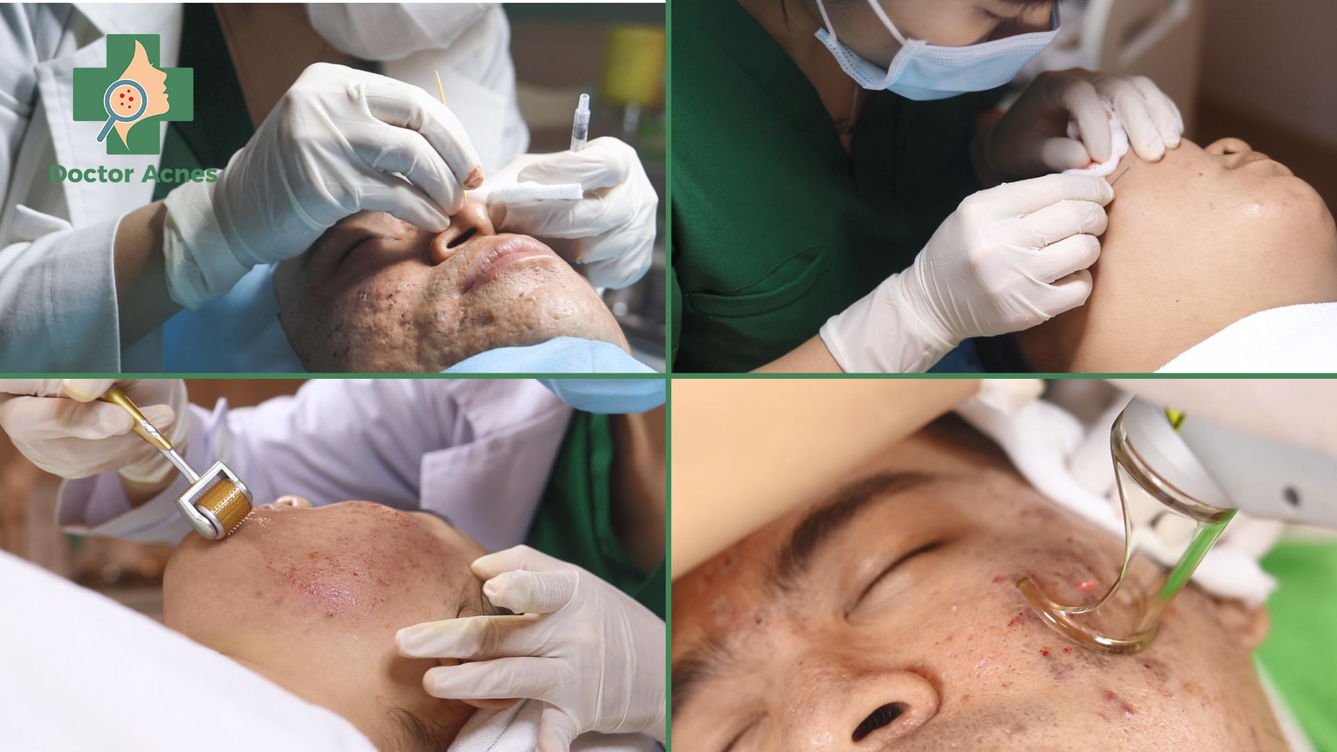 Các phương pháp trị sẹo điẻn hình Doctor Acnes