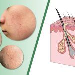 Mụn ẩn là gì? Nguyên nhân, biểu hiện và cách điều trị hiệu quả