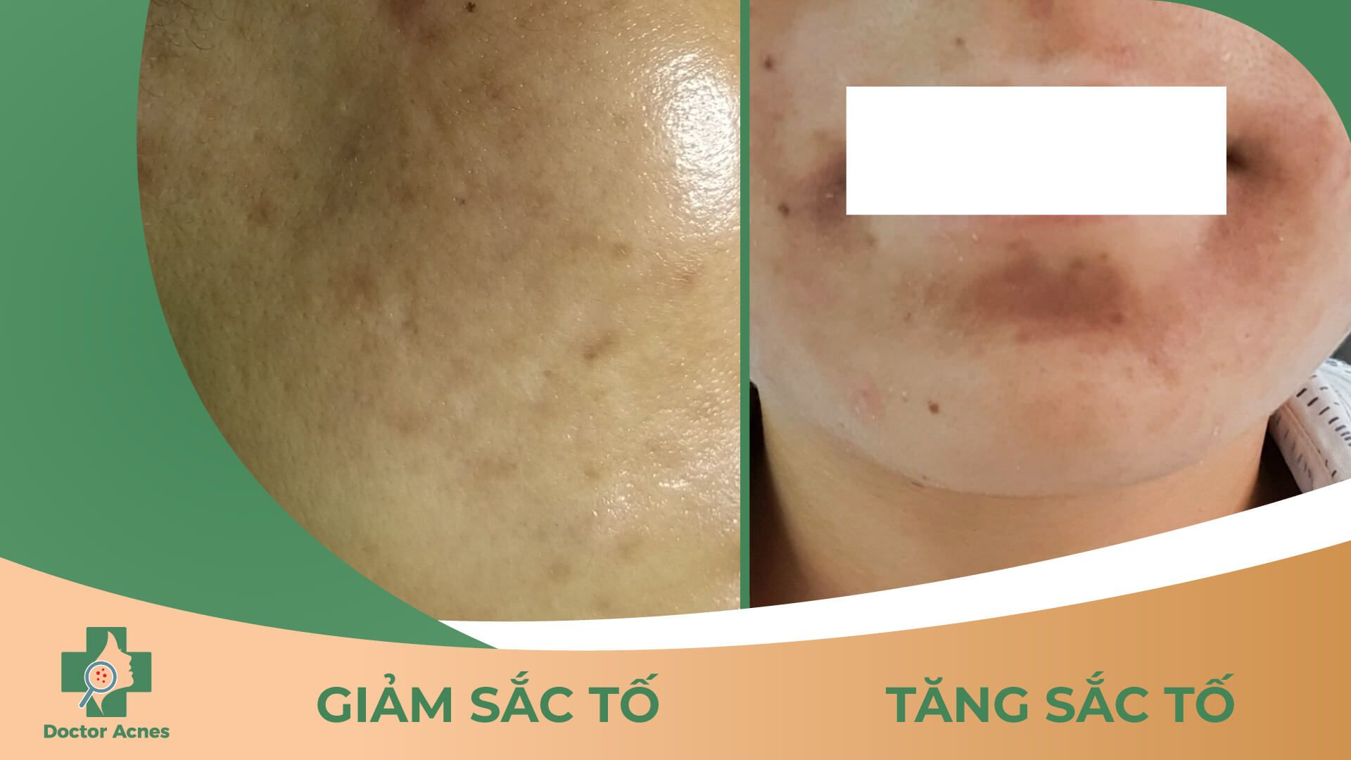 Biến chứng giảm sắc tố và tăng sắc tố sau khi peel da