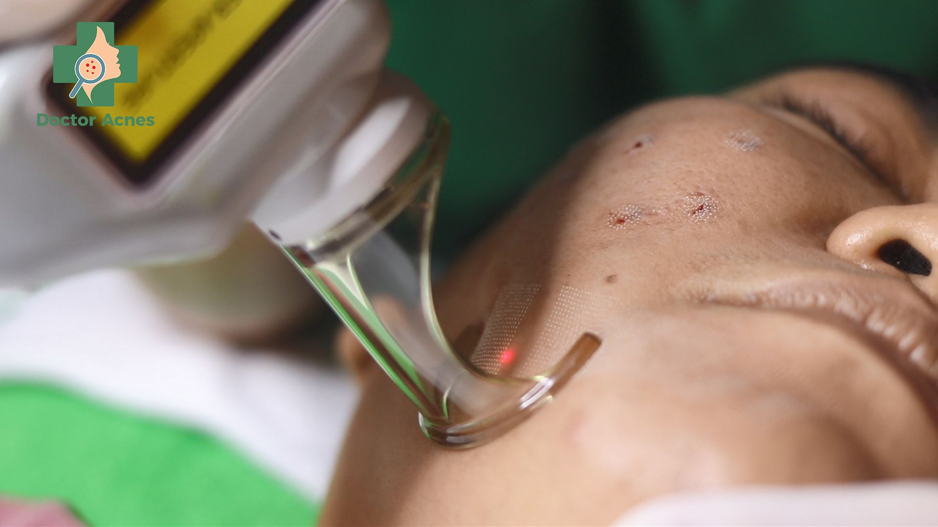laser fractional co2 điều trị sẹo