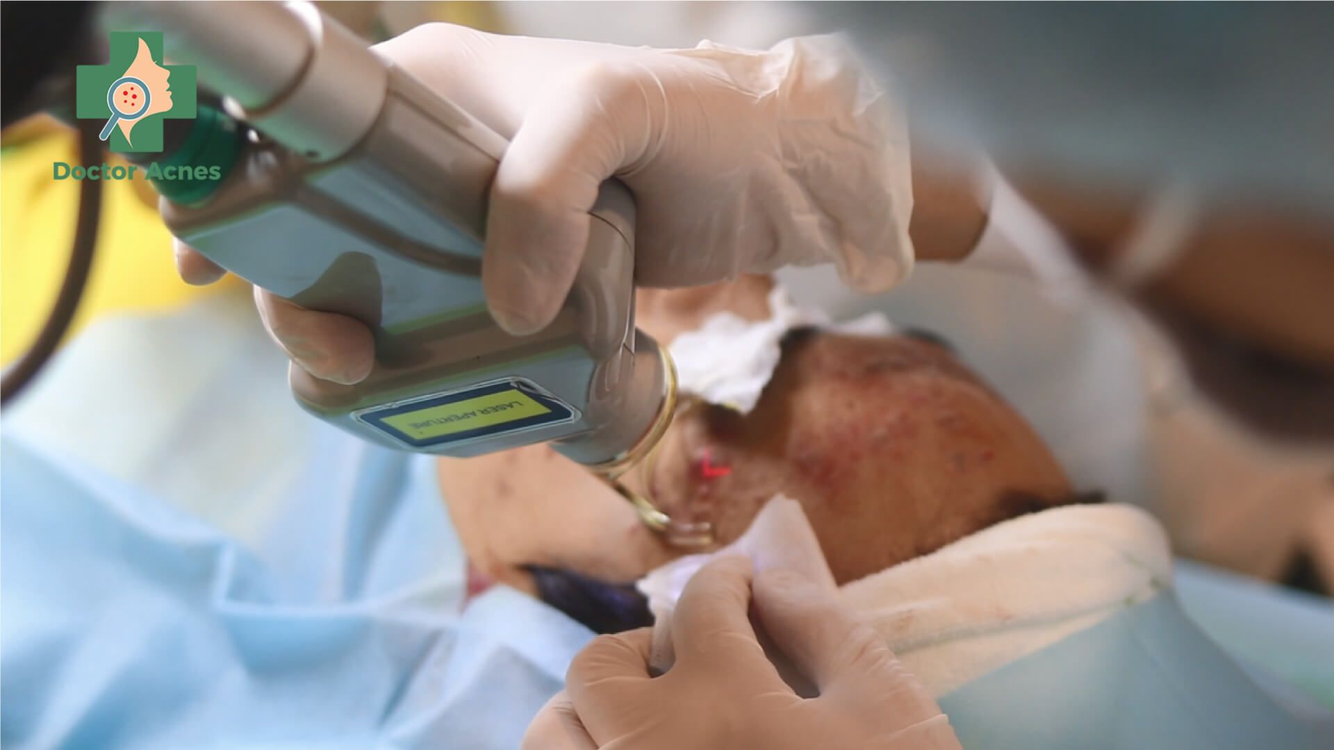 Laser fractional CO2 trị sẹo tại Doctor Acnes
