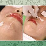 Peel da trị mụn là gì? Ưu và nhược điểm trong điều trị mụn