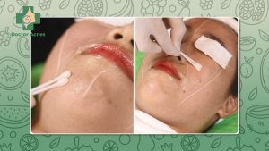 Peel da - Doctor Acnes