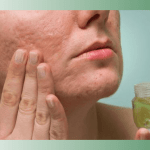 Vitamin E điều trị sẹo rỗ có thực sự hiệu quả?