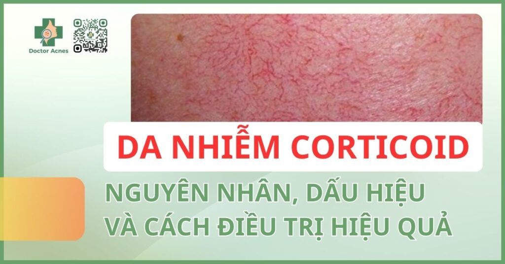 da nhiễm corticoid nguyên nhân, dấu hiệu và cách điều trị hiệu quả