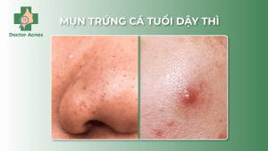 cách trị mụn tuổi dậy thì