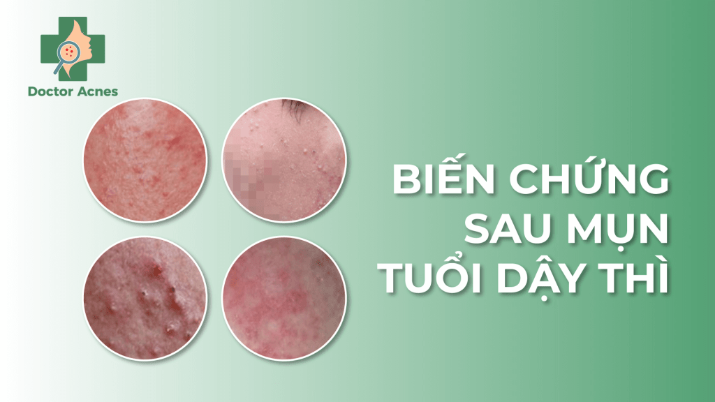 banner biến chứng sau mụn tuổi dậy thì - Doctor Acnes