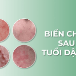 Làm thế nào để hạn chế biến chứng khi bị mụn ở tuổi dậy thì