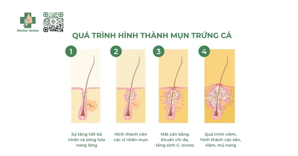 quá trình hình thành mụn trứng cá