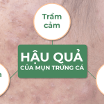 Những hậu quả thường gặp của mụn trứng cá và cách điều trị