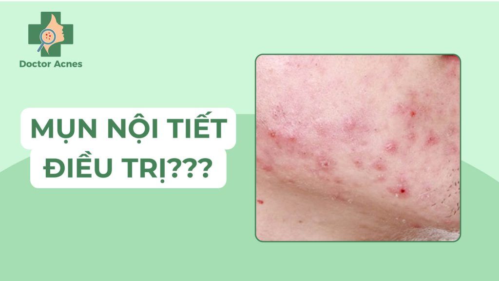 Banner mụn nội tiết - Doctor Acnes