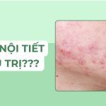 Mụn nội tiết ở người trưởng thành