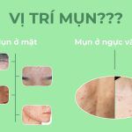 Vị trí mụn trên cơ thể nói lên điều gì?