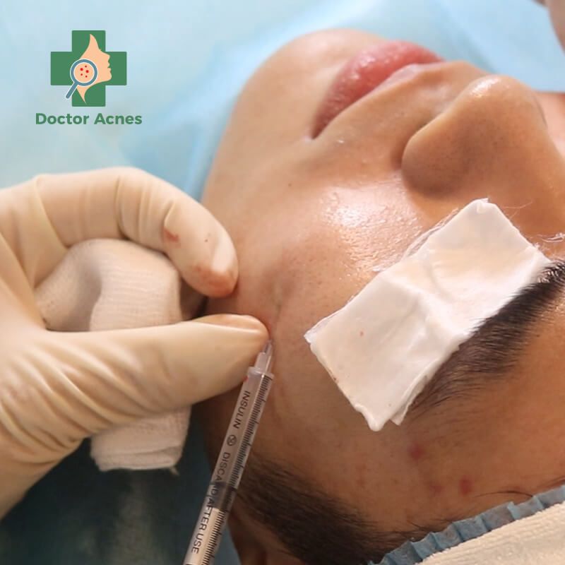 Mesotherapy PRP