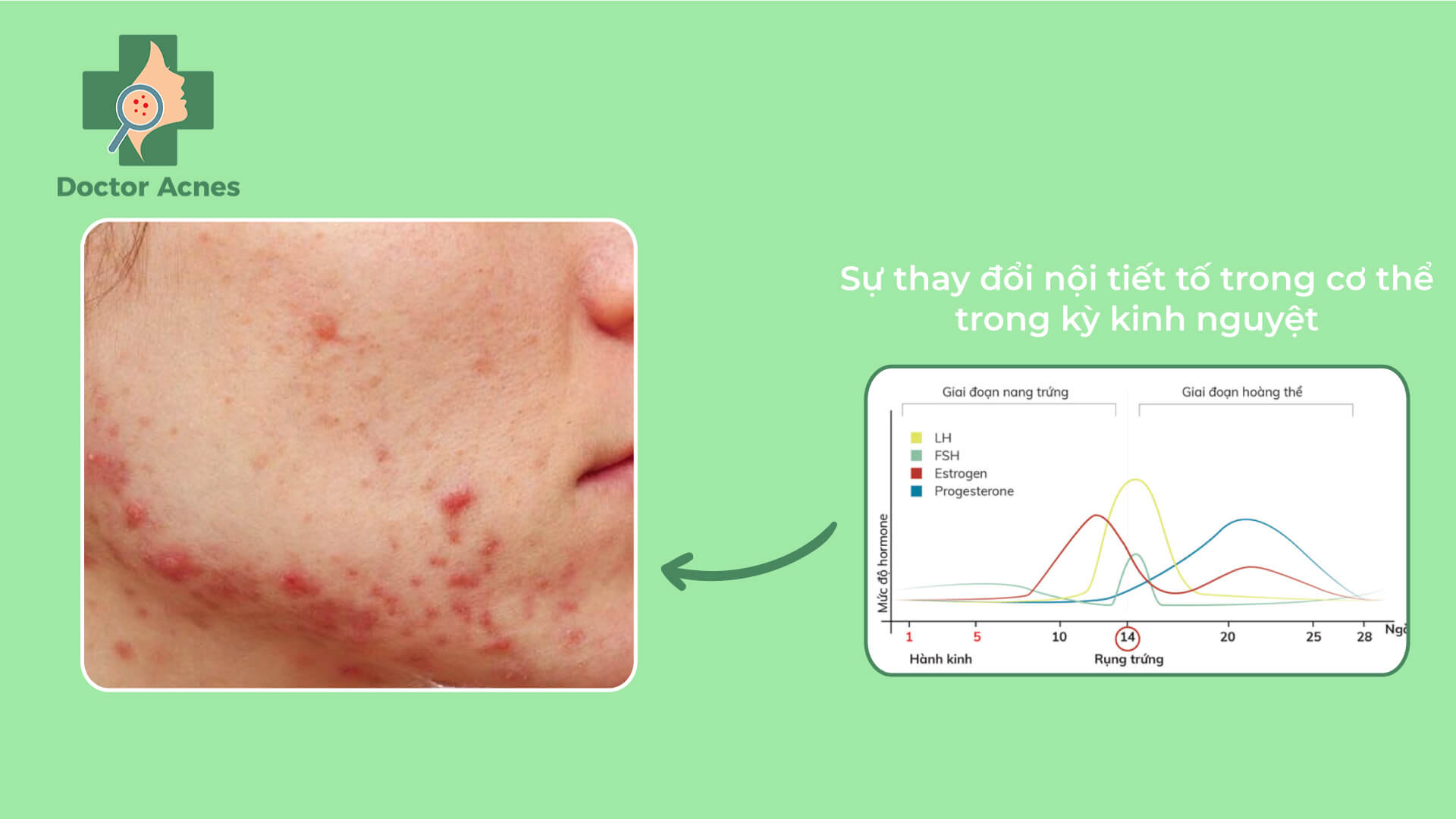 Mụn mọc ở cằm và quanh hàm - Doctor Acnes