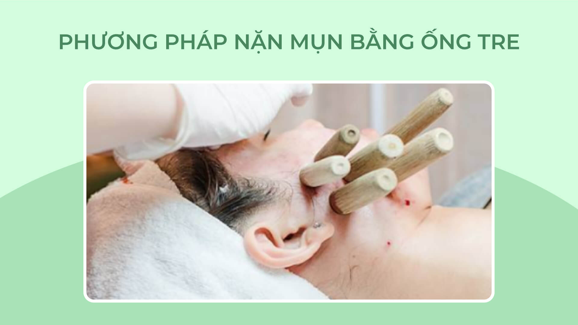 Phương pháp nặn mụn ống tre tại spa - Doctor Acnes