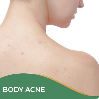 Body Acne Treatment