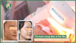 thumb Kiều Liên hành trình trị mụn Doctor Acnes