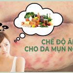 Chế độ ăn cho người bị mụn nội tiết