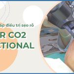 Laser CO2 fractional có trị được sẹo rỗ lâu năm không?