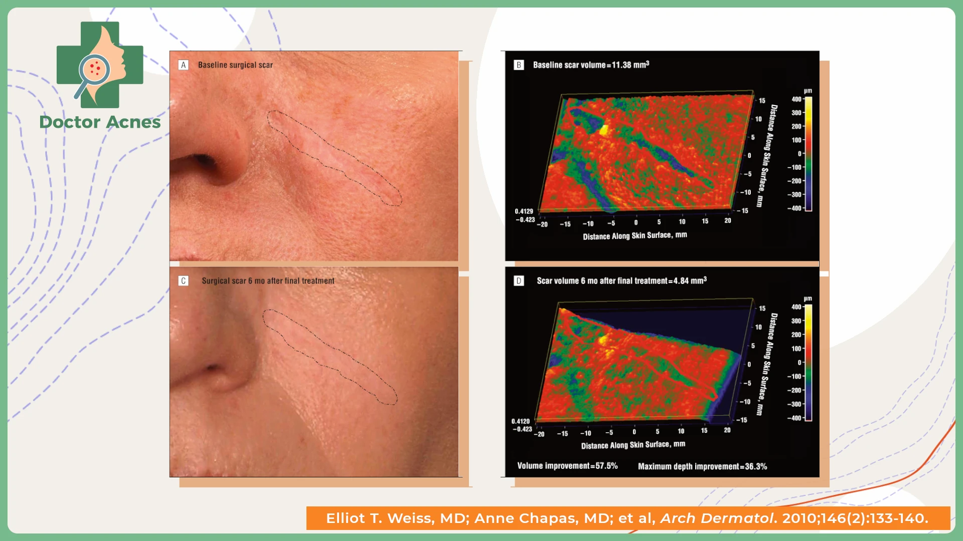 Tình trạng sẹo rỗ được cải thiện trong liệu trình điều trị 6 tháng với laser CO2 Fractional