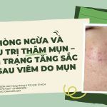 Điều trị da bị tăng sắc tố sau viêm hiệu quả chuẩn y khoa