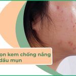 5 cách chọn kem chống nắng cho da dầu mụn