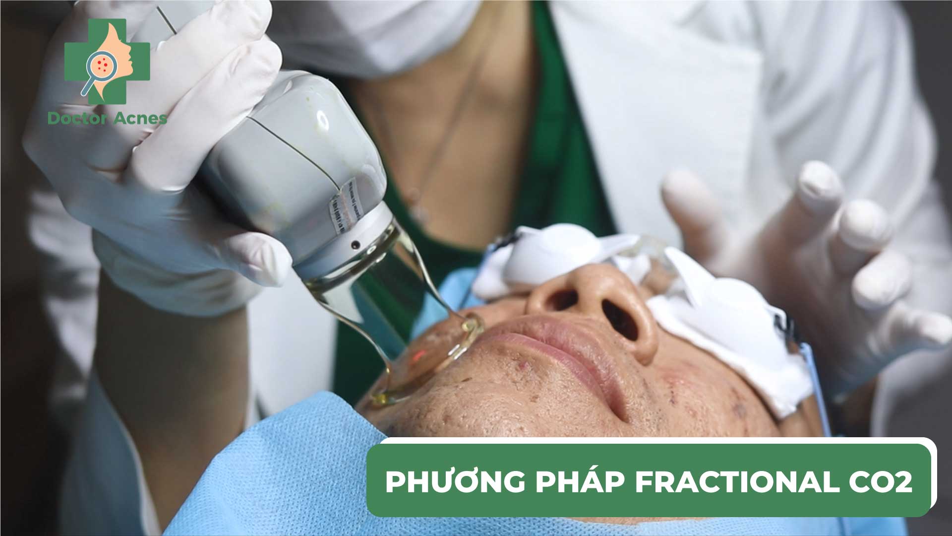 Fractional CO2 điều trị sẹo rỗ - Doctor Acnes