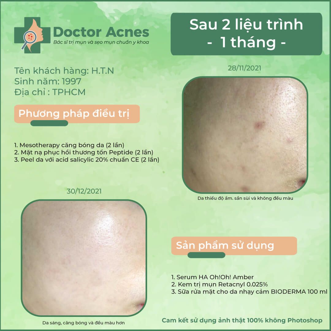 Hiệu quả mesotherapy 280122 Doctor Acnes