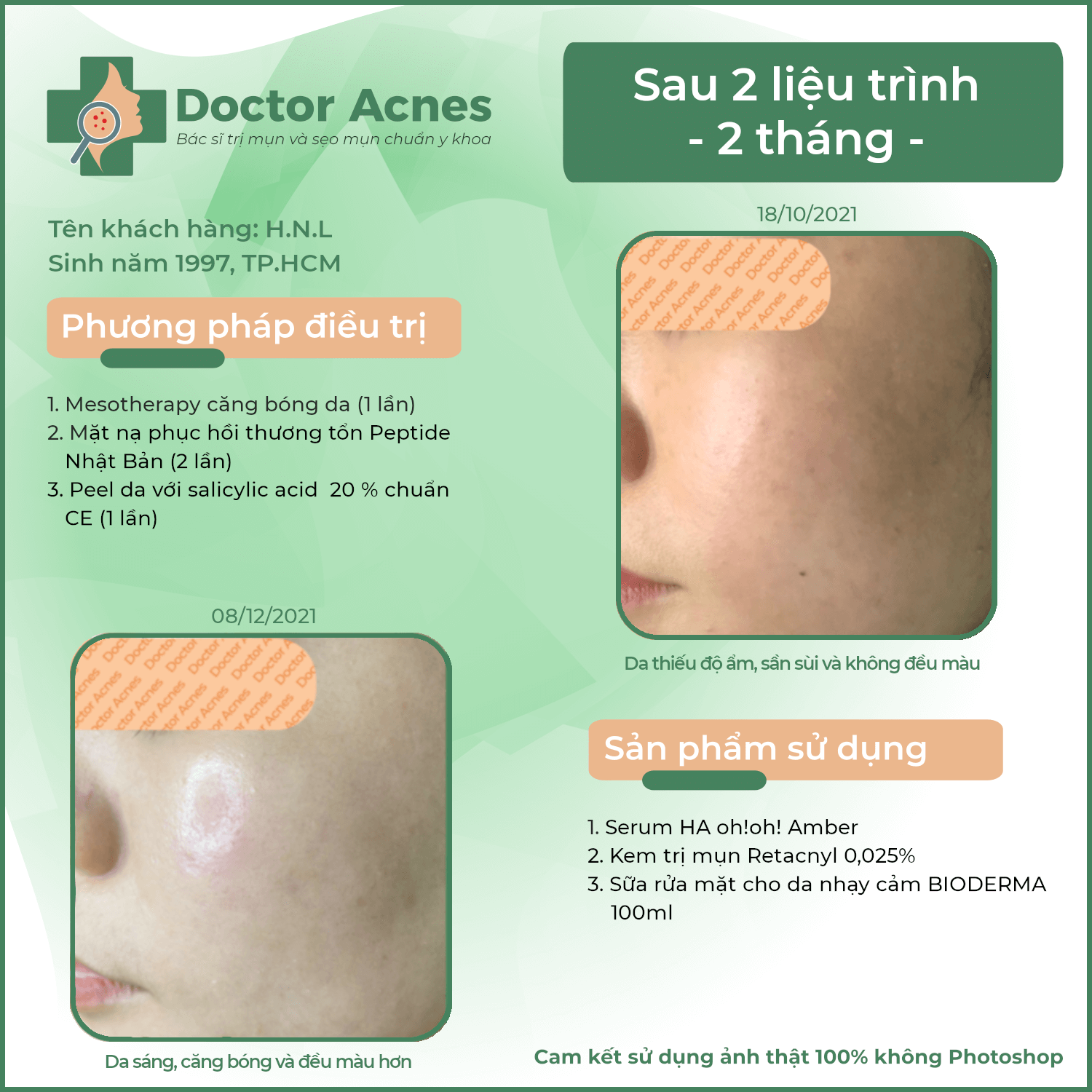 Hiệu quả mesotherapy Doctor Acnes 081221