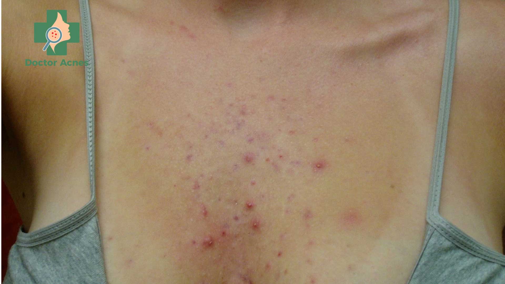Mụn ở ngực - Doctor Acnes