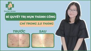 Thumb Ánh Phương trị mụn - Doctor Acnes