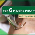 Top 6 phương pháp trị sẹo rỗ hiệu quả nhất hiện nay 
