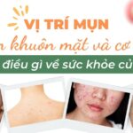 Vị trí mụn trên khuôn mặt và cơ thể nói lên điều gì về sức khỏe của bạn?