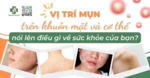 vị trí mụn trên cơ thể và khuôn mặt nói lên điều gì về sức khỏe của bạn