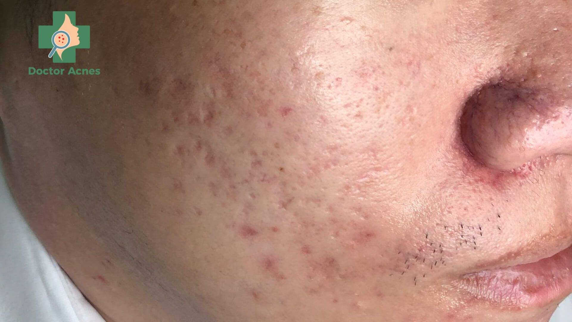 Sẹo rỗ - Doctor Acnes