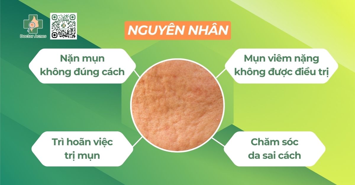 nguyên nhân sẹo rỗ